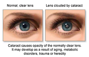 Cataract